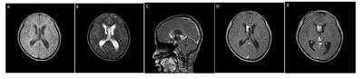 Hemophagocytic lymphohistiocytosis during treatment of intracranial multifocal germinoma: a case report and literature review